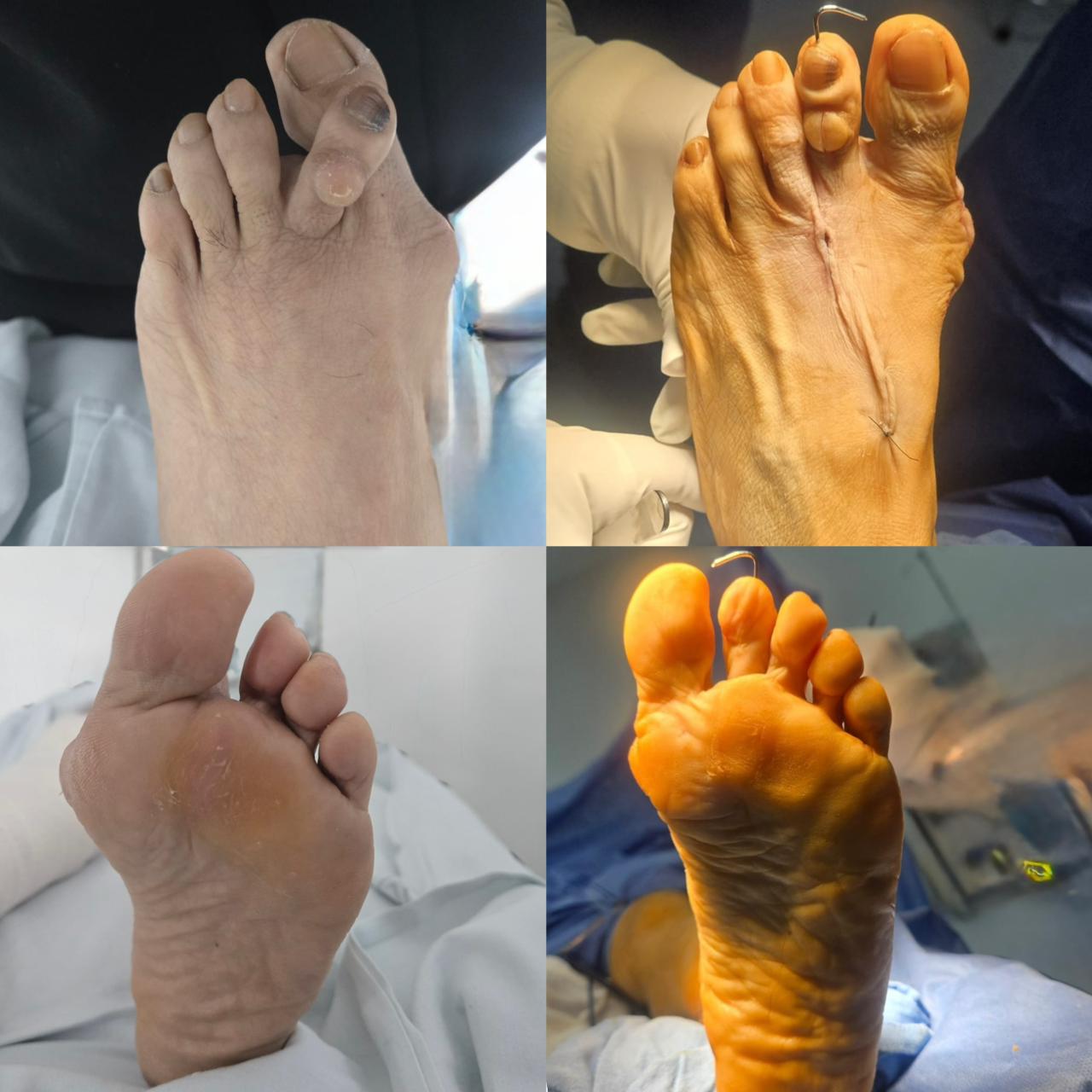 Deformidades en los Pies